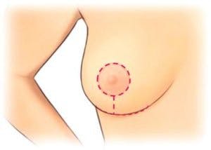 Anchor incision for auto augmentation breast enlargement