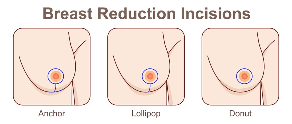 breast_reduction_incision.jpg
