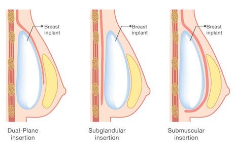 implant placement for breast enlargement and uplift