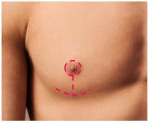 male breast reduction anchor incision
