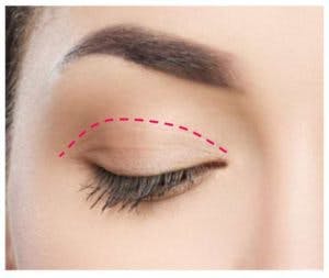 upper eyelid surgery incision