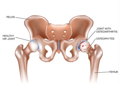 hip osteo diagram.jpg