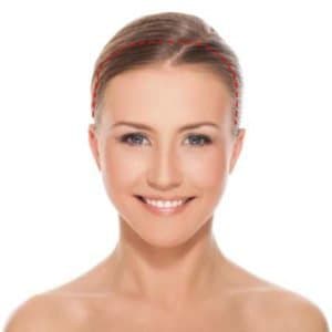 open brow lift incision