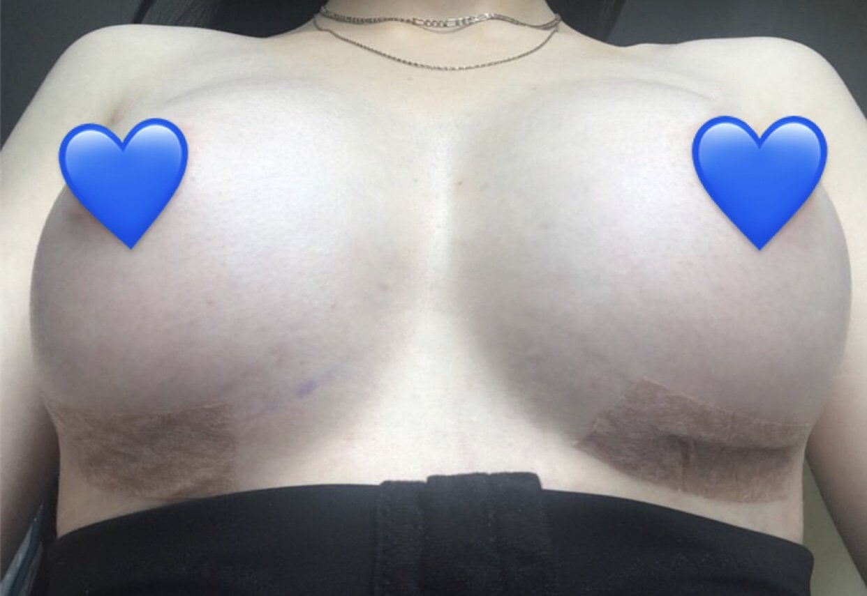 2 weeks post-op image 2