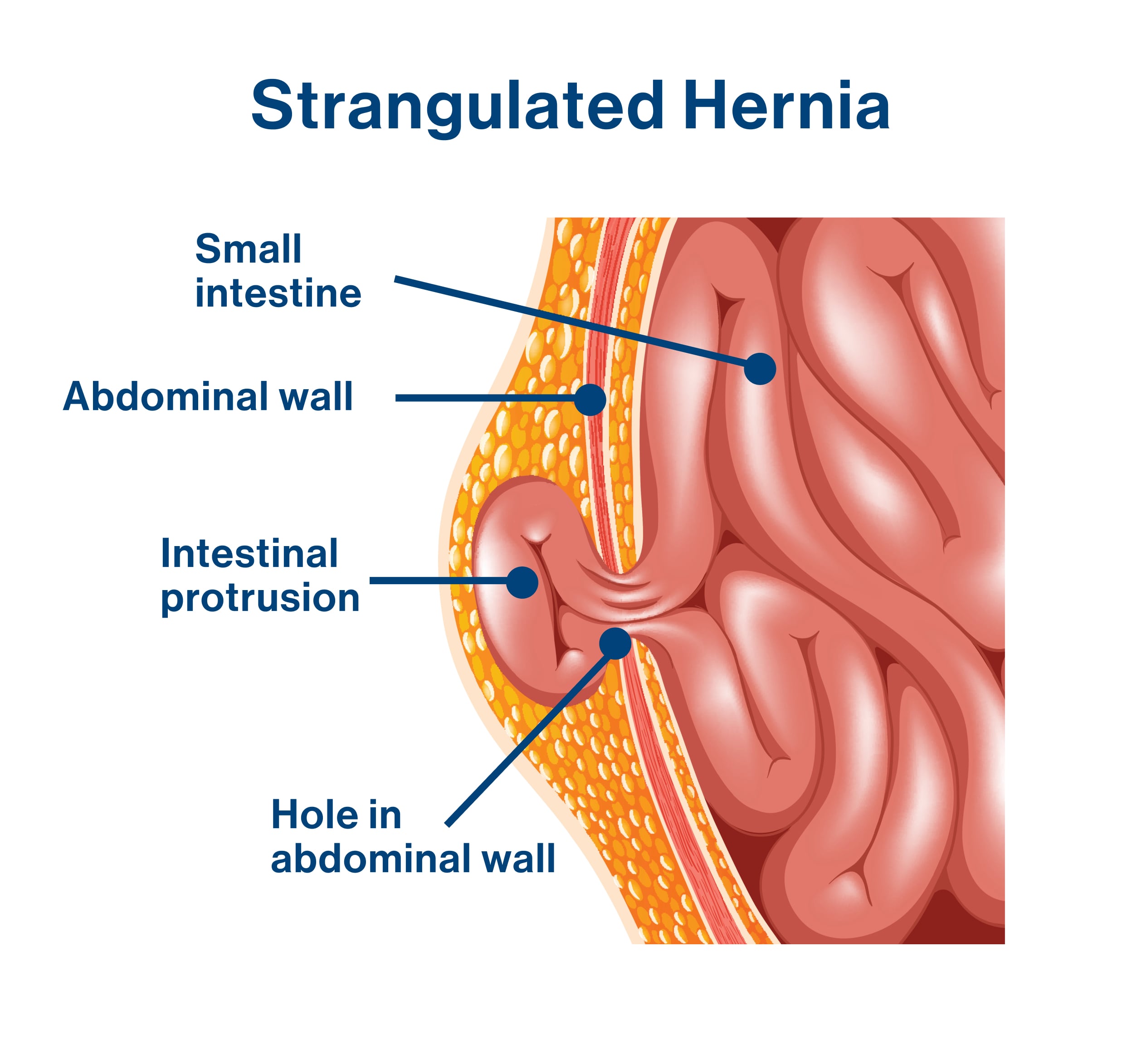 23_11_30_px_Image_StrangulatedHernia