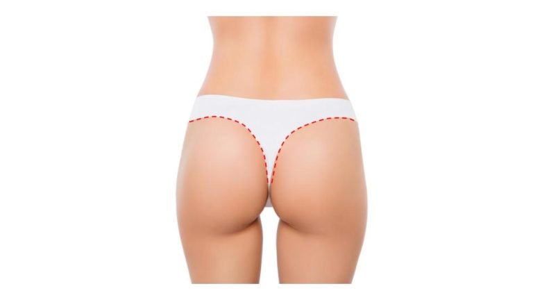 Butterfly-Buttock-Lift_Incision-768x432.jpg