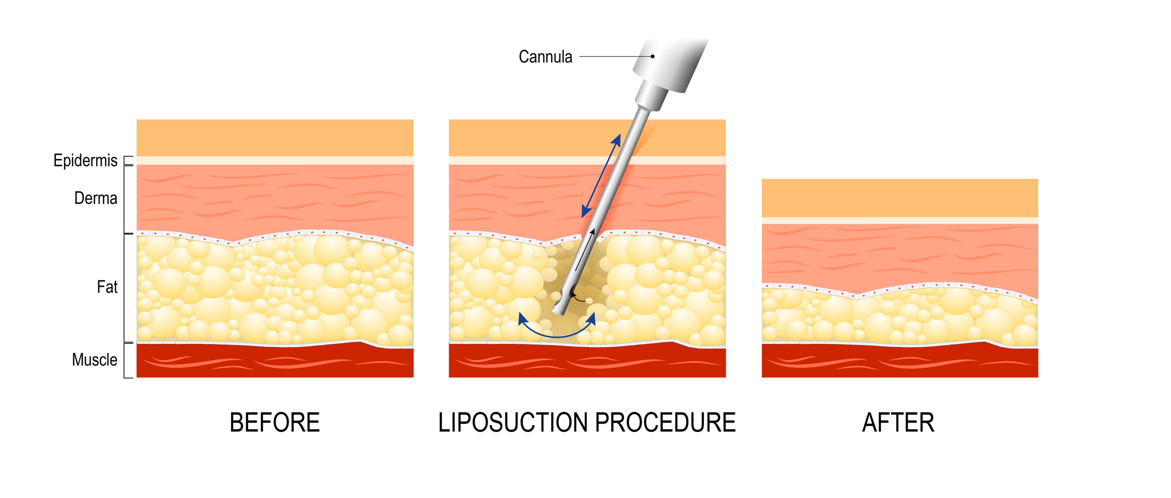 liposuction for fat transfer breast enlargement