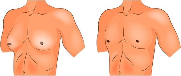 male breast reduction before and after