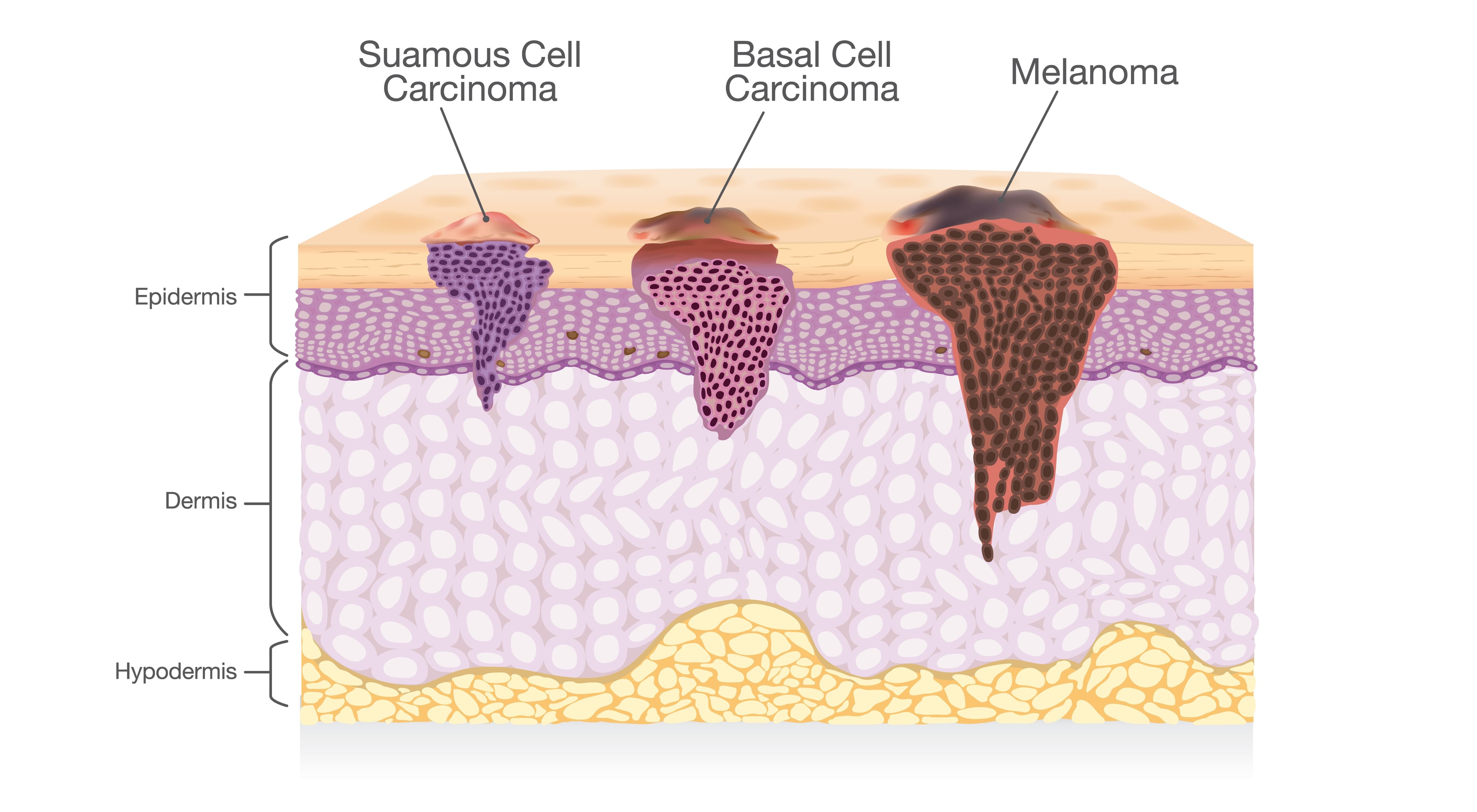 types of skin cancer