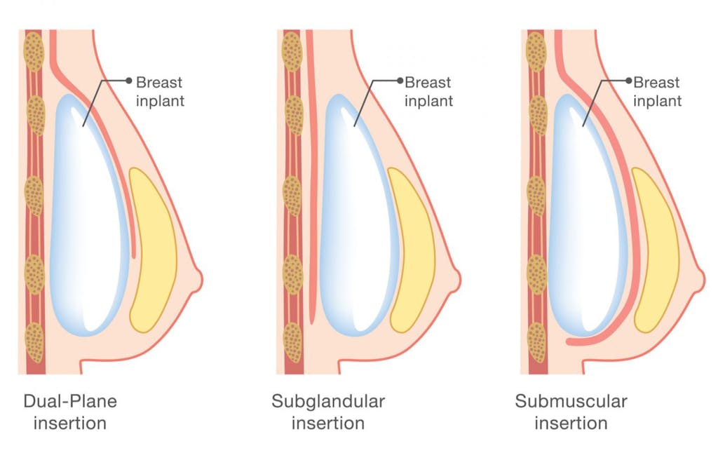 breast-implant.jpg