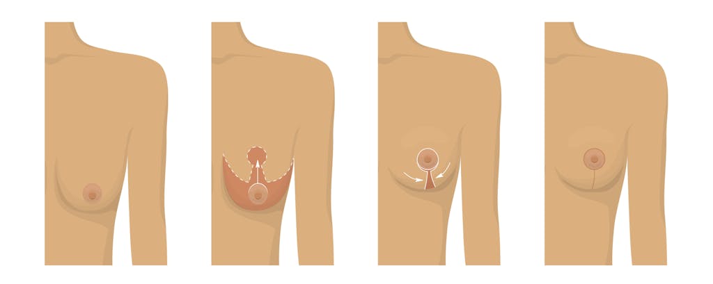 breast lift illustration