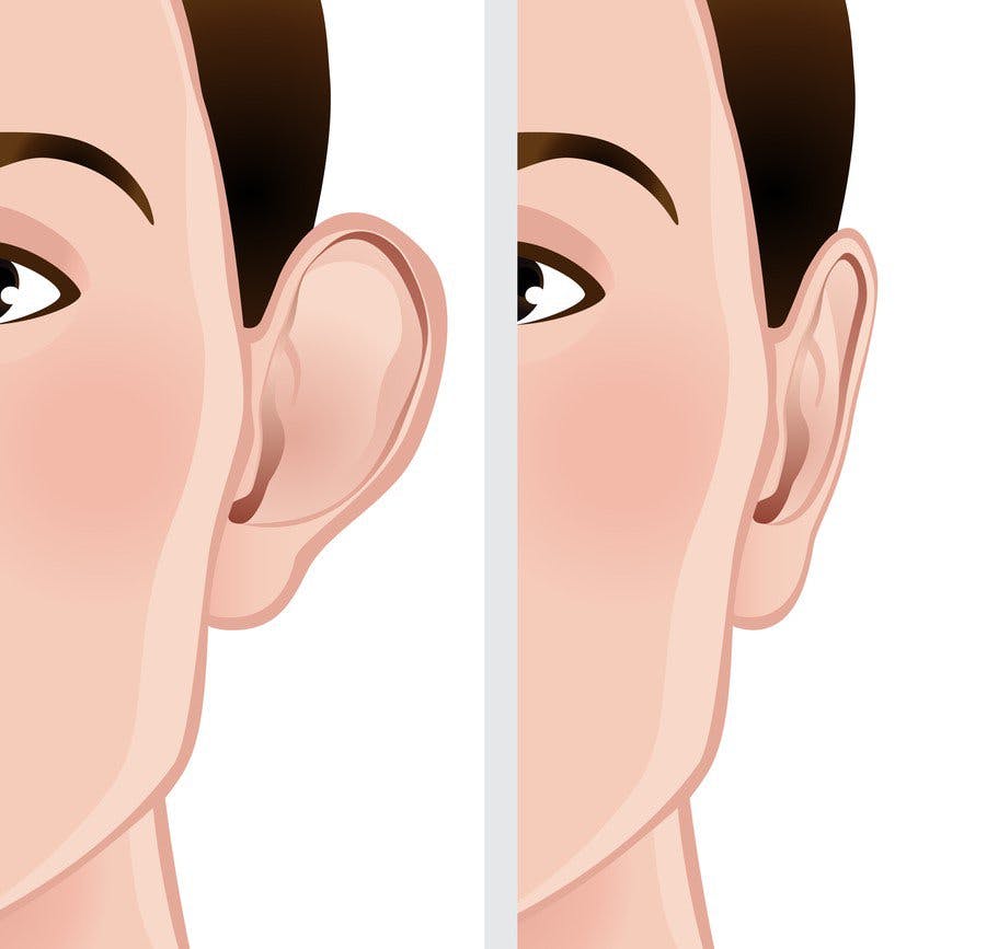 ear pinning illustration