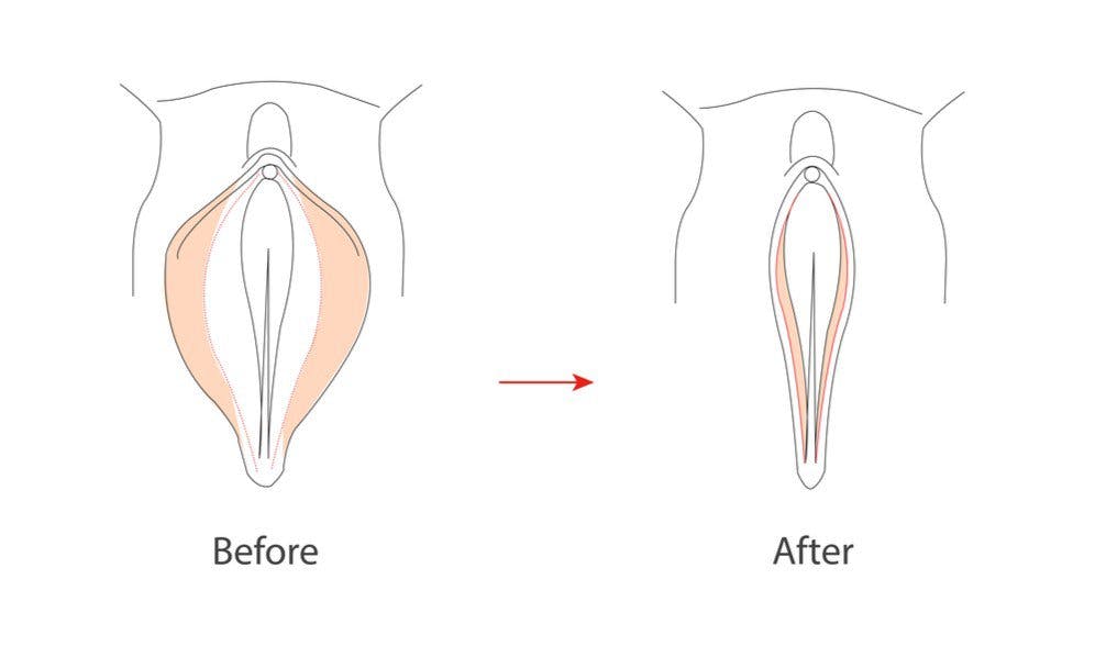 Labiaplasty illustration