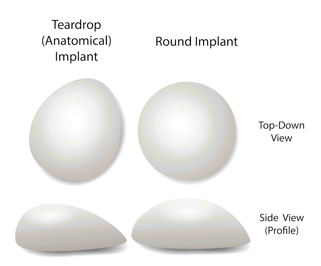 Breast implant shapes types breast enlargement