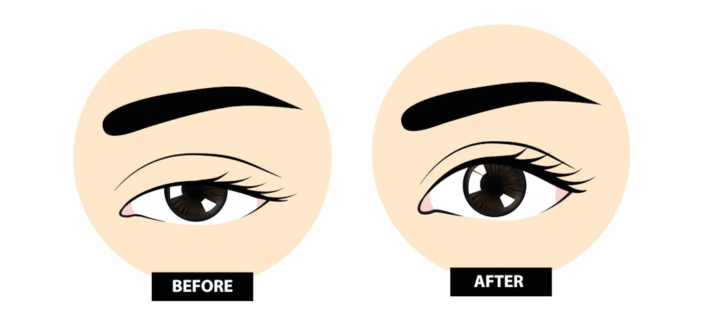 Eye ptosis surgery before and after