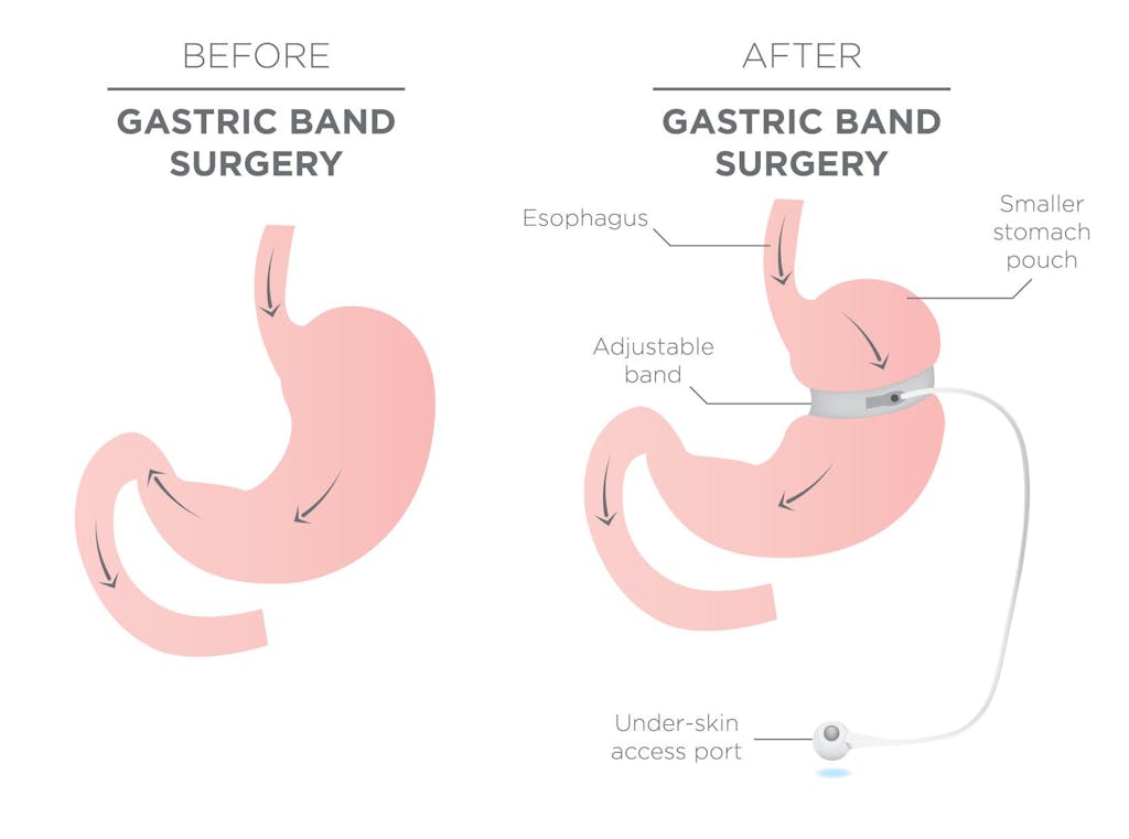 Gastric band before and after