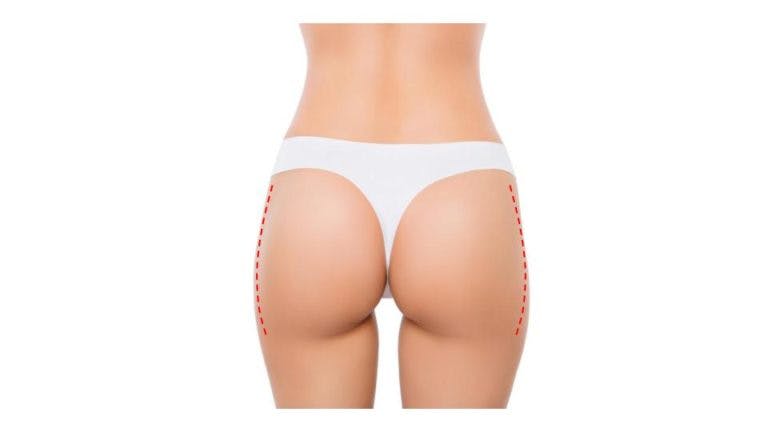 Lateral-Buttock-Lift_Incision-768x432.jpg