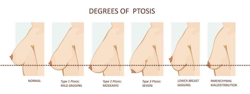 Ptosis Diagram