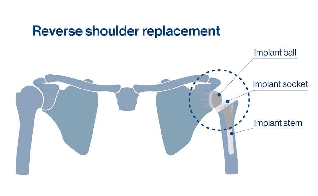 Reverse shoulder replacement diagram