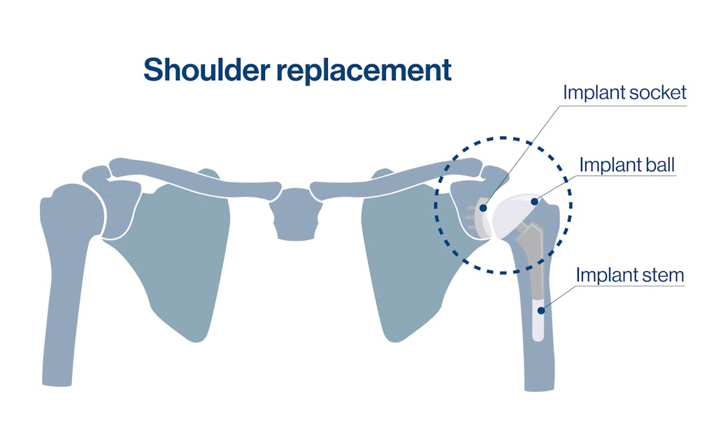 Shoulder replacement diagram
