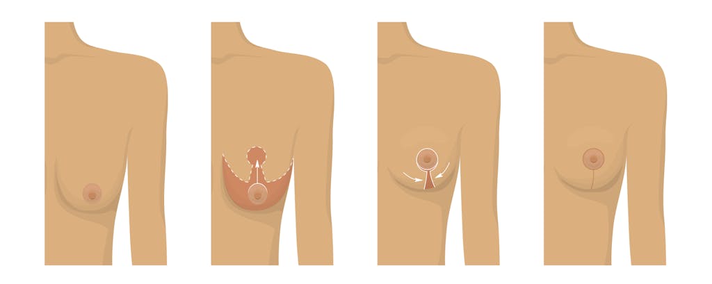 breast lift illustration