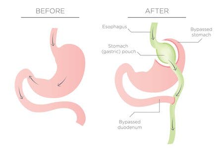 gastric bypass before and after
