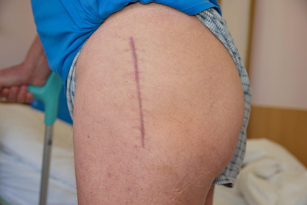 hip_surgery_results_scar_post_op