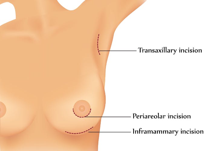 incisions_breast_enlargement_augmentation.jpg