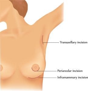 incisions for gender affirmation breast enlargement