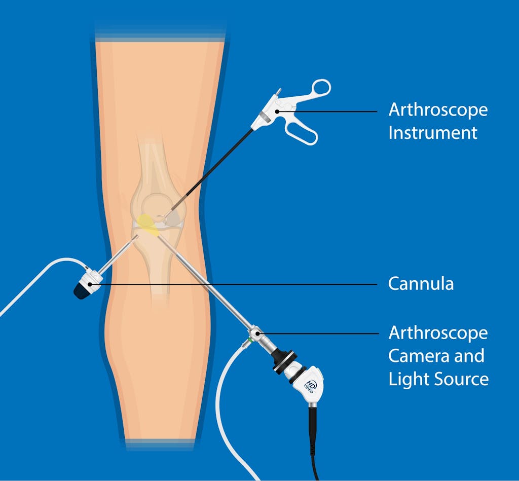 knee arthroscopy diagram.jpg