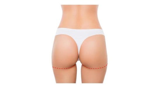lower buttock lift incision