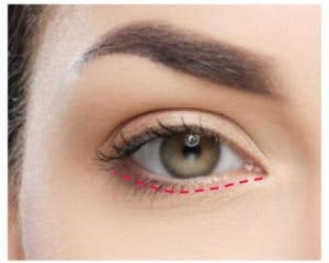 lower eyelid surgery incision