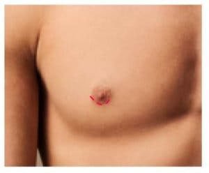 male breast reduction periareolar incision