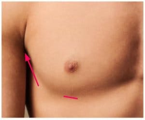 male breast reduction via liposuction