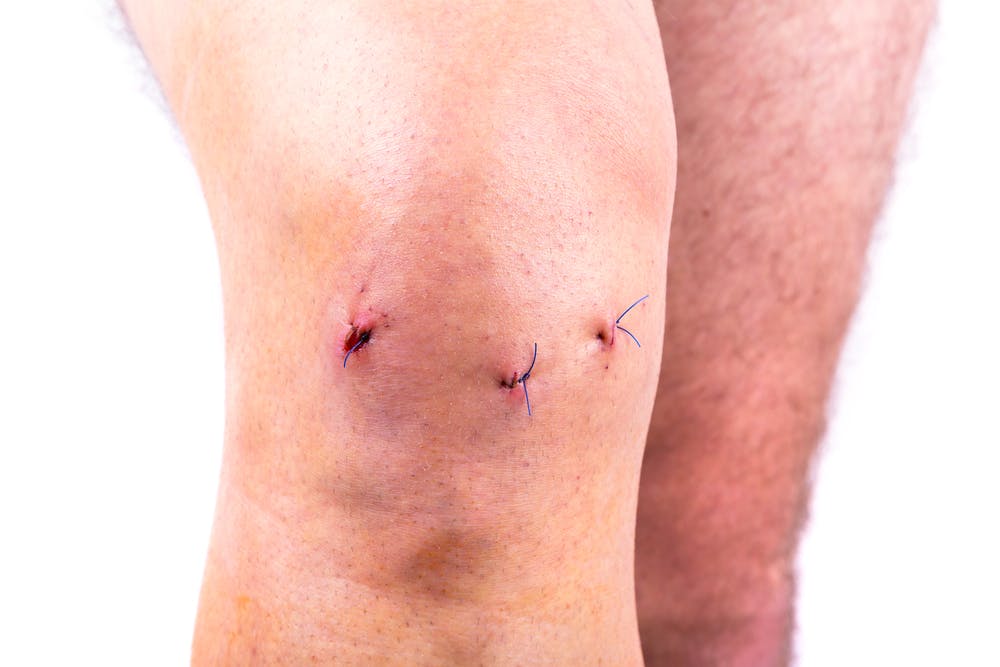 meniscus repair incisions.jpg