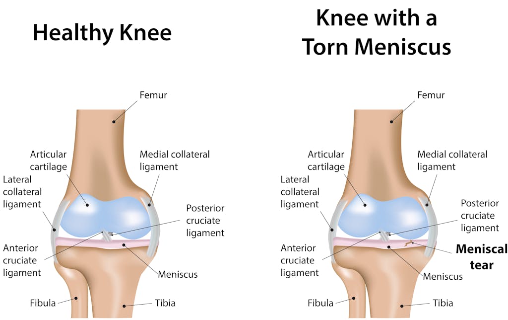 meniscus tear.jpg