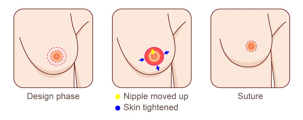 nipple reduction surgery diagram