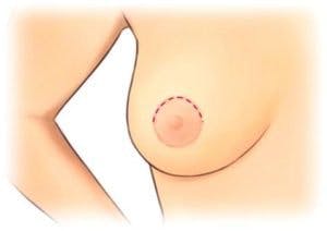 periareolar incision for breast enlargement and lift
