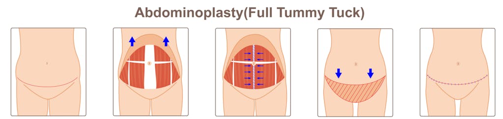 Abdominoplasty Tummy Tuck diagram