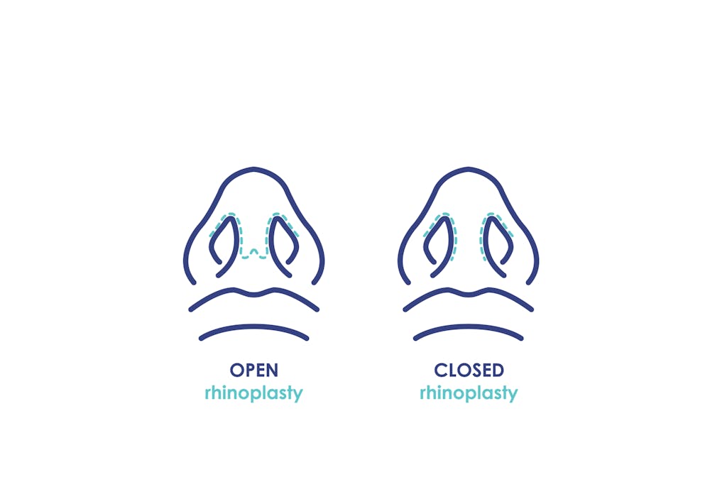 Open and closed Rhinoplasty